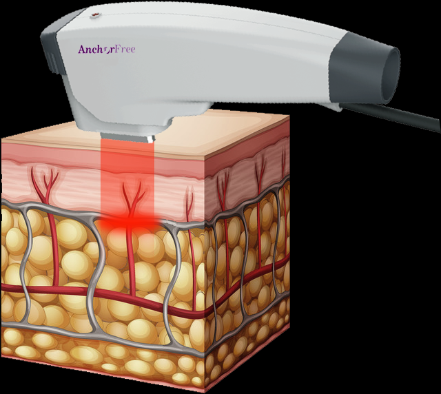 The Scientific Principle of Skin Tightening and Remodeling Caused by RF Machine