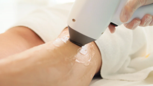 Laser hair removal