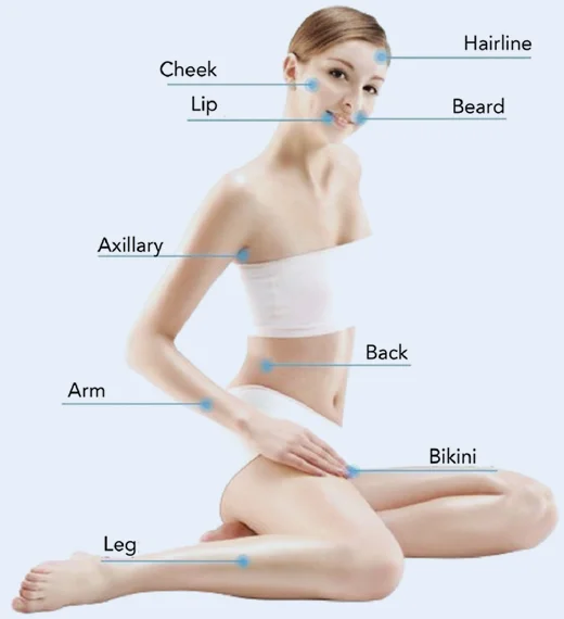 What Makes the 808nm Diode Laser Hair Removal Machine So Effective